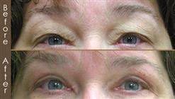 Eyelid Surgery Results